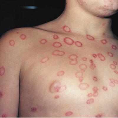Itchy Skin Rash - Medical Pictures