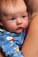 Is It A Viral Rash Baby Toddler Rash Identification Ask Dr Sears