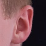 Child’s Ear Infection Causing Redness and Swelling of the Ear
