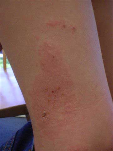 Baby rash on legs