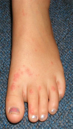 hand, foot and mouth disease